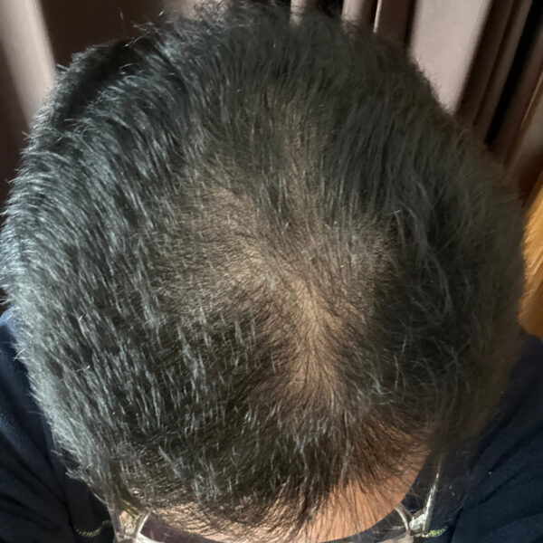 薄毛改善の検証実験開始より6ヶ月経過後　頭頂部状態　画像